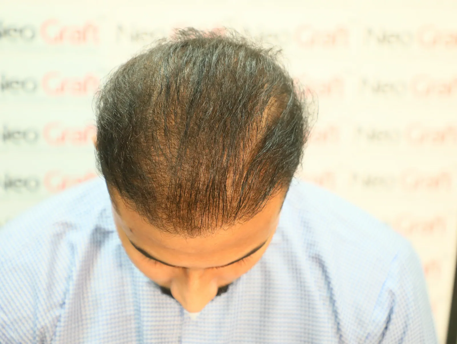 Previous FUE Hair Transplant Improved with Scalp Micropigmentation — Before